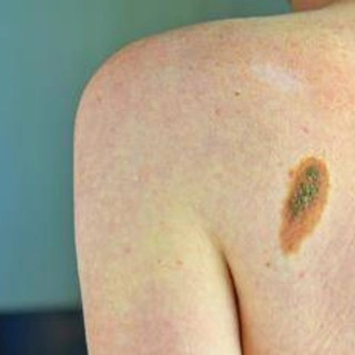 L'oncologo Ascierto: &quot;Aumentano casi melanoma, lampade abbronzanti come fumo&quot;